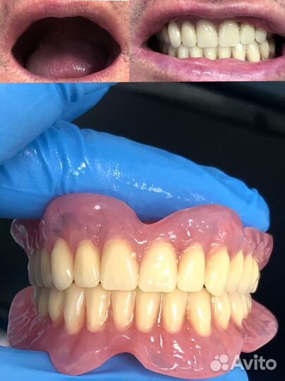 Съемные зубные протезы с выездом на дом. Зубы