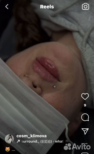 Контурная пластика губ