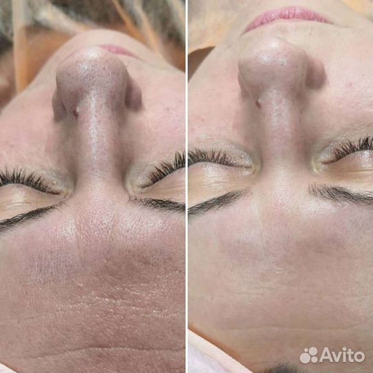 Комбинированная чистка лица