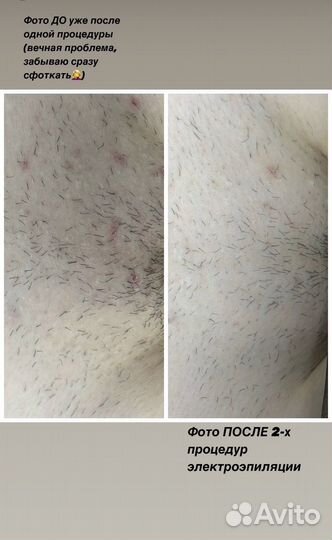 Электроэпиляция лицо и тело