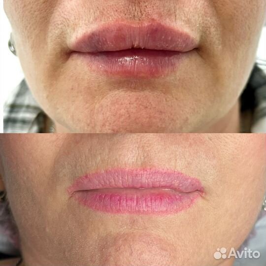 Увеличение губ