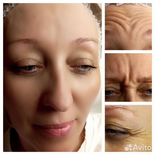 Инъекции ботокса в лоб