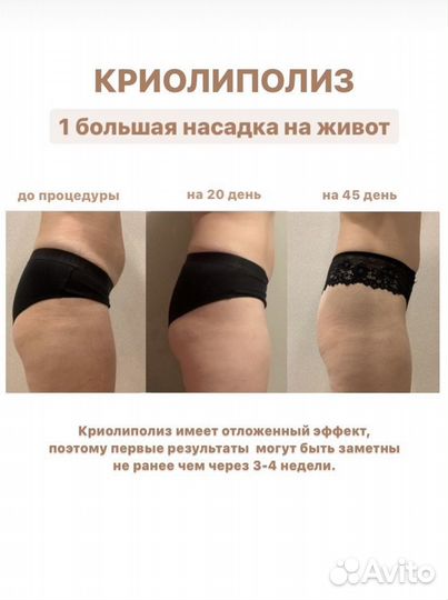 Криолиполиз