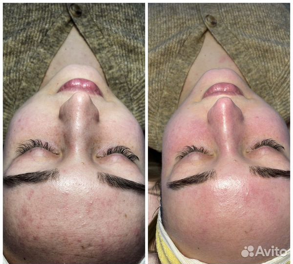 Атравматичная чистка лица