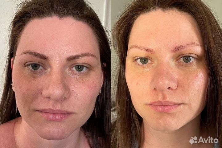 Карамельная липосакция