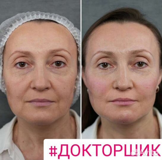 Контурная пластика