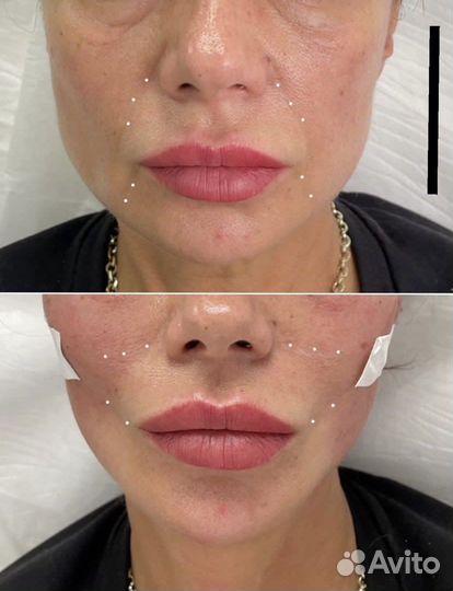 Подтяжка лица, брыли, мезонити, золотые нити