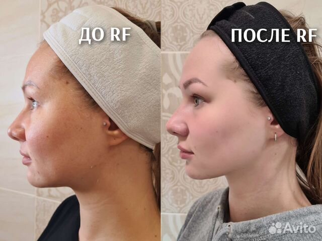 Микротоковая терапия