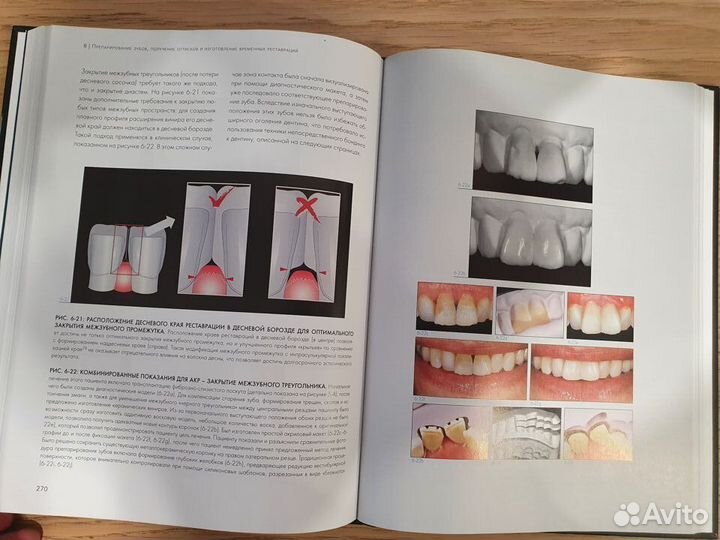 Адгезивные керамические реставрации передних зубов