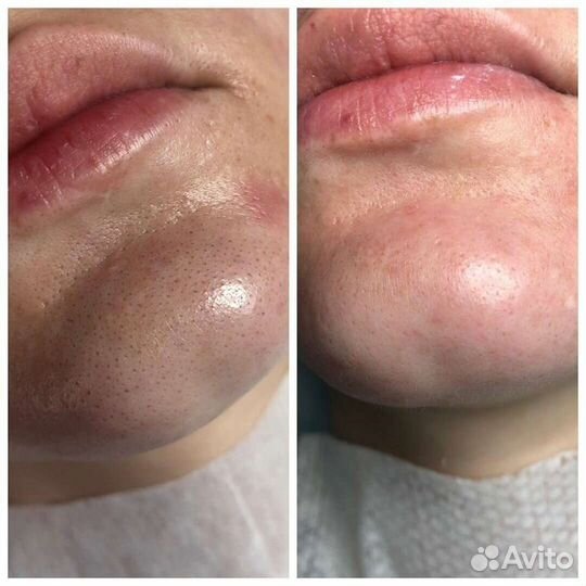 Комбинированная чистка лица