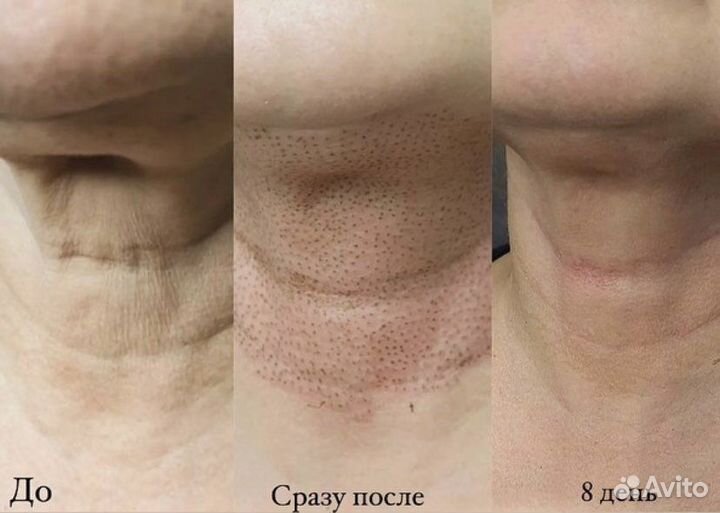Безоперационная блефаропластика
