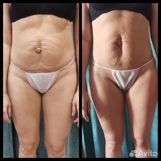 Антицеллюлитный массаж выезд на дом