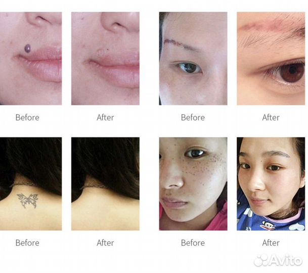 Лазерная ручка для удаление