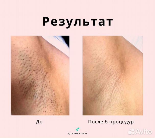 Аппарат для эпиляции «Lumines» Макс Ван 1200W