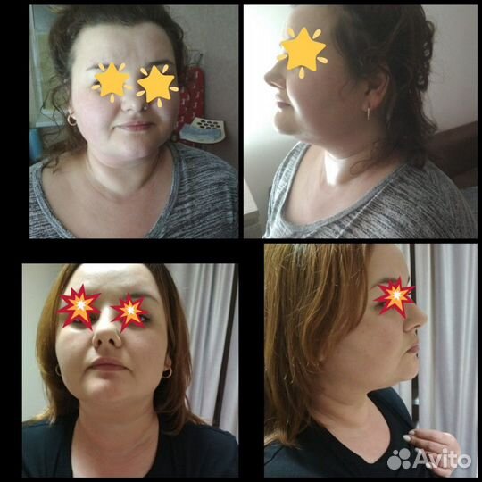 RF-лифтинг. Аппаратная косметология