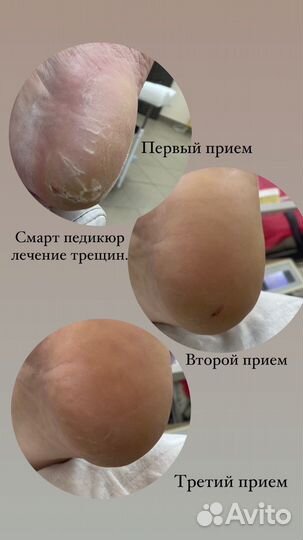 Подолг в Солнцево. Проблемные ногти и пятки