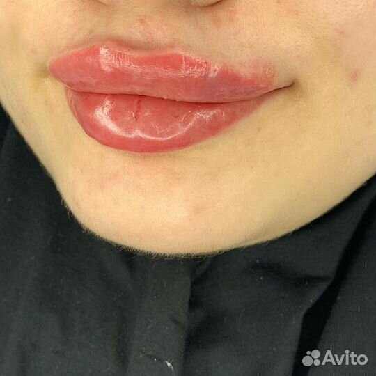 Увеличение губ модель