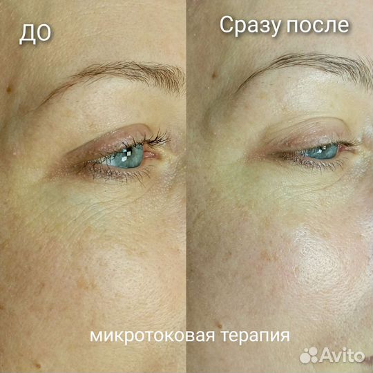 Микротоковая терапия