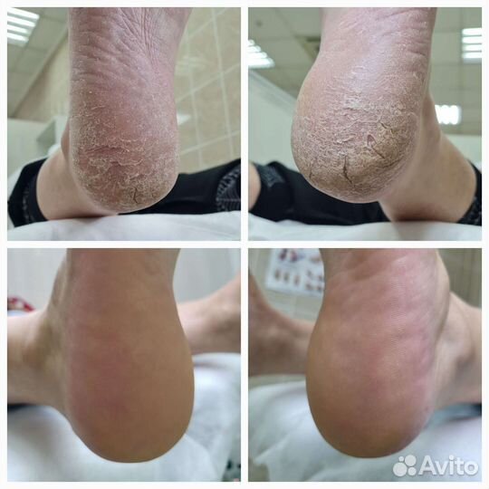 Коррекция вросшего ногтя