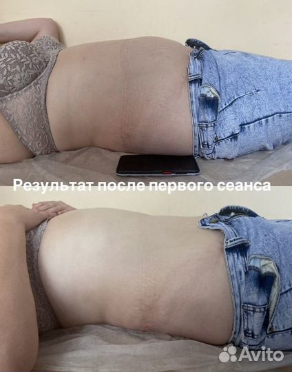 Криолиполиз