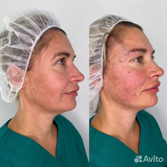 Косметолог-дерматолог/увелечение губ/Смас-лифтинг