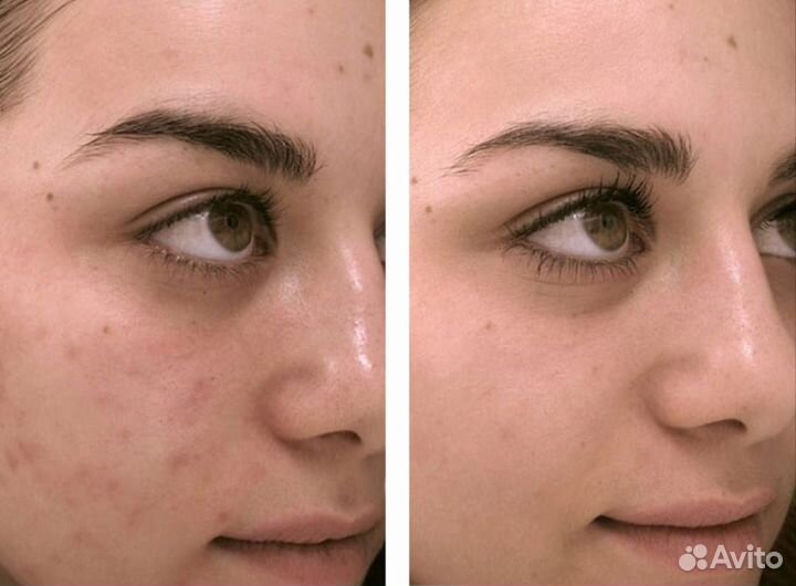 Чистка лица,комплекс (HydraFacial)