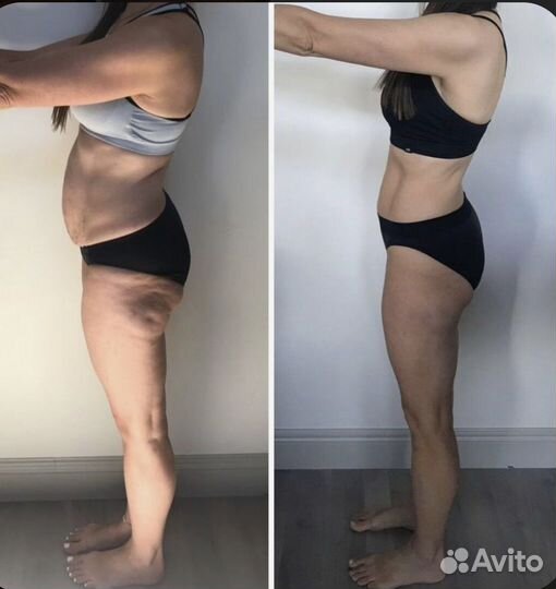 LPG массаж Антицеллюлитный