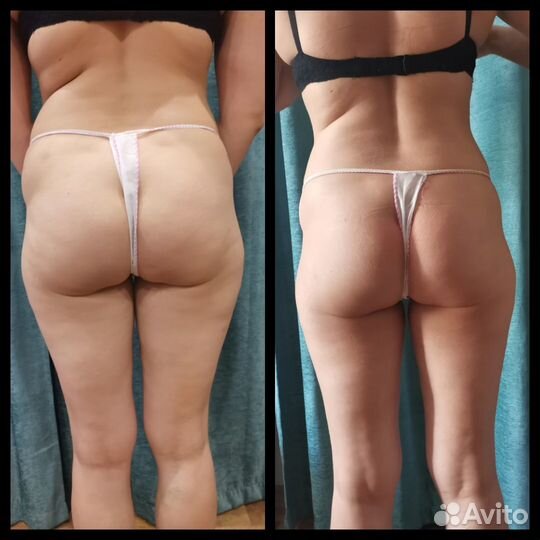 Антицеллюлитный массаж выезд на дом