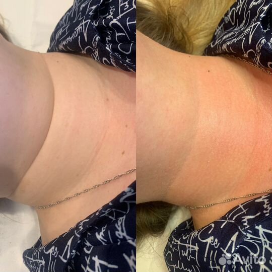 Холодная плазма. Обучение