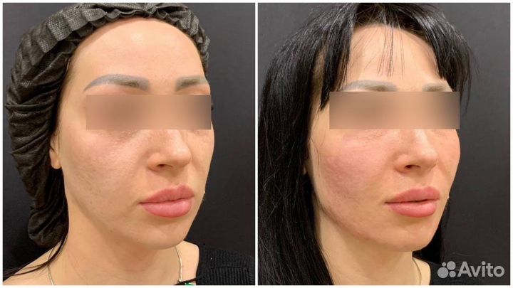 Фулл фейс лифтинг лица