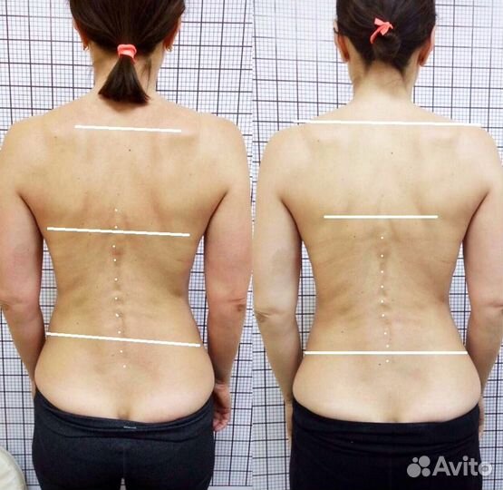 Коррекция осанки, массаж