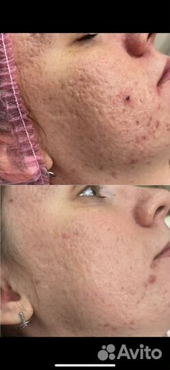 Лазерная шлифовка