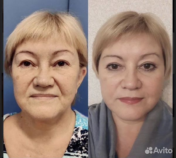 Элос Омоложение и Эпиляция