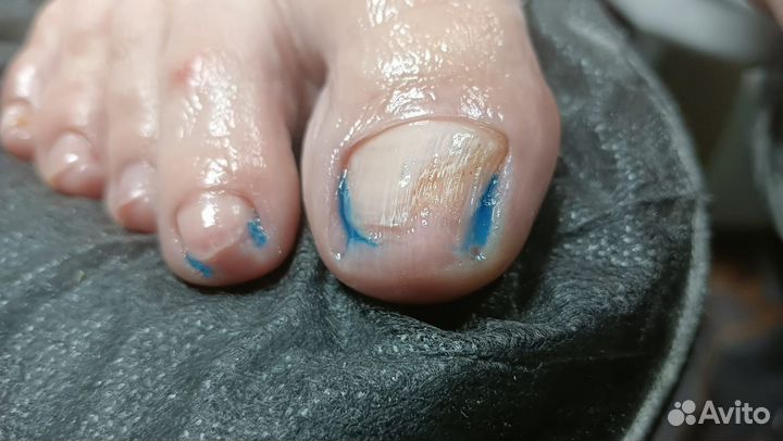 Педикюр подолог, вросший ноготь