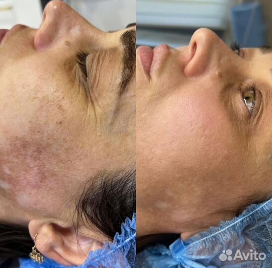 Фотоомоложение люмекка (Lumecca)