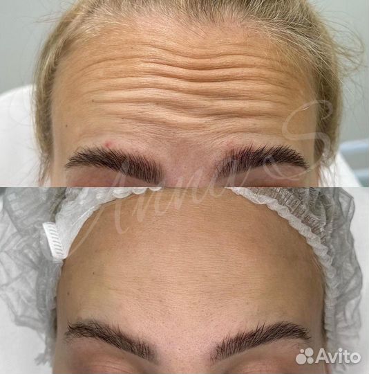 Ботокс для лица