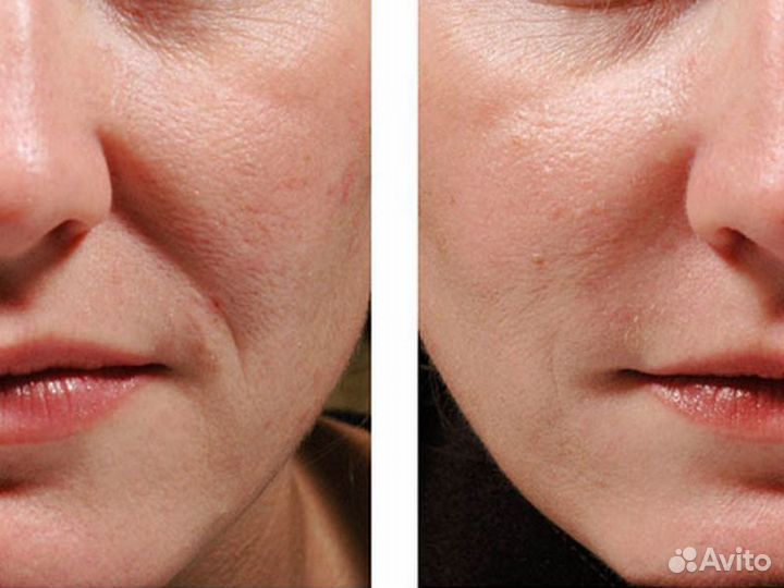 Носогубные складки