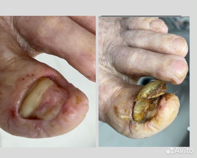 Педикюр подолог