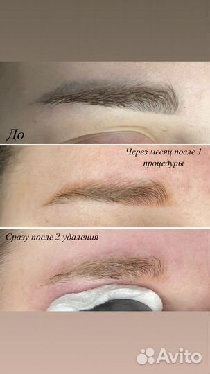 Лазерное удаление татуажа/тату