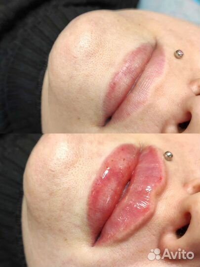 Биоревитализация