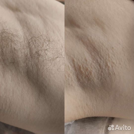 Депиляция воском: бёдра