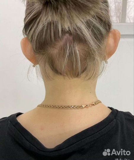 Отопластика нитевая