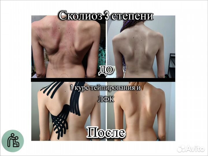 Спортивное / косметическое тейпирование