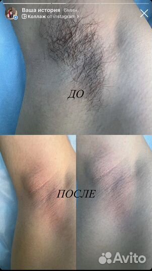 Шугаринг женский