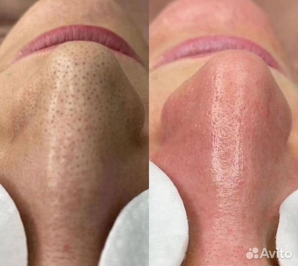 Чистка лица