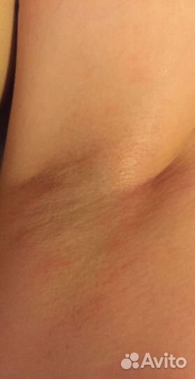 Эпиляция (шугаринг)