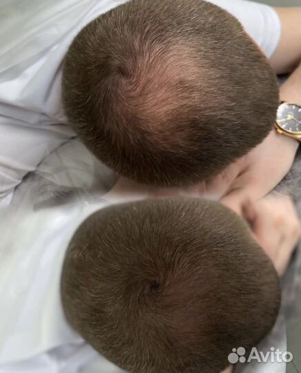 Татуаж Залысина Трихопигментация (камуфляж/тату )