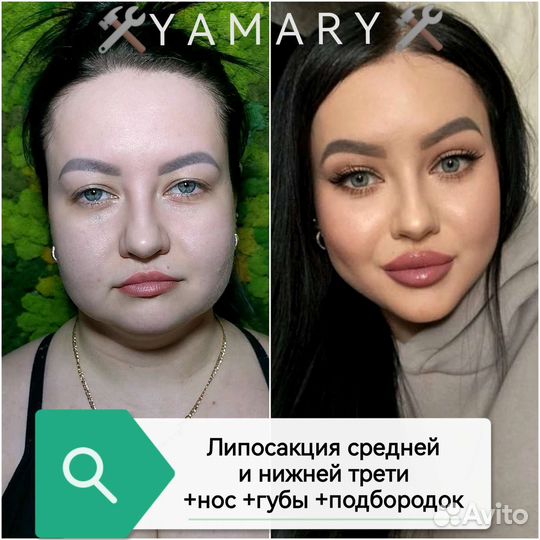 Липоредукция подбородка. Косметолог