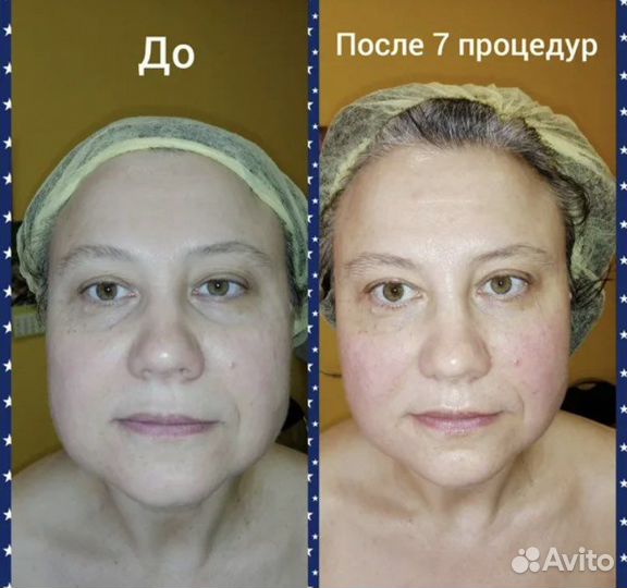 Буккальный массаж