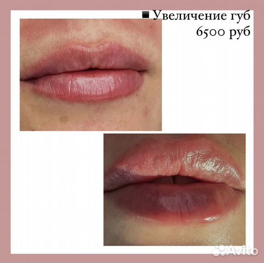 Косметолог. Пирсинги. Перманент, RF-лифтинг